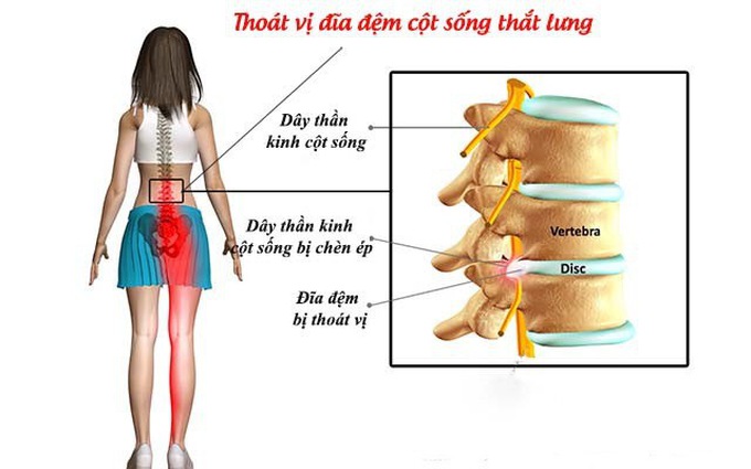 Thoát vị đĩa đệm cột sống thắt lưng là nguyên nhân thường gặp nhất gây hội chứng đôi ngựa